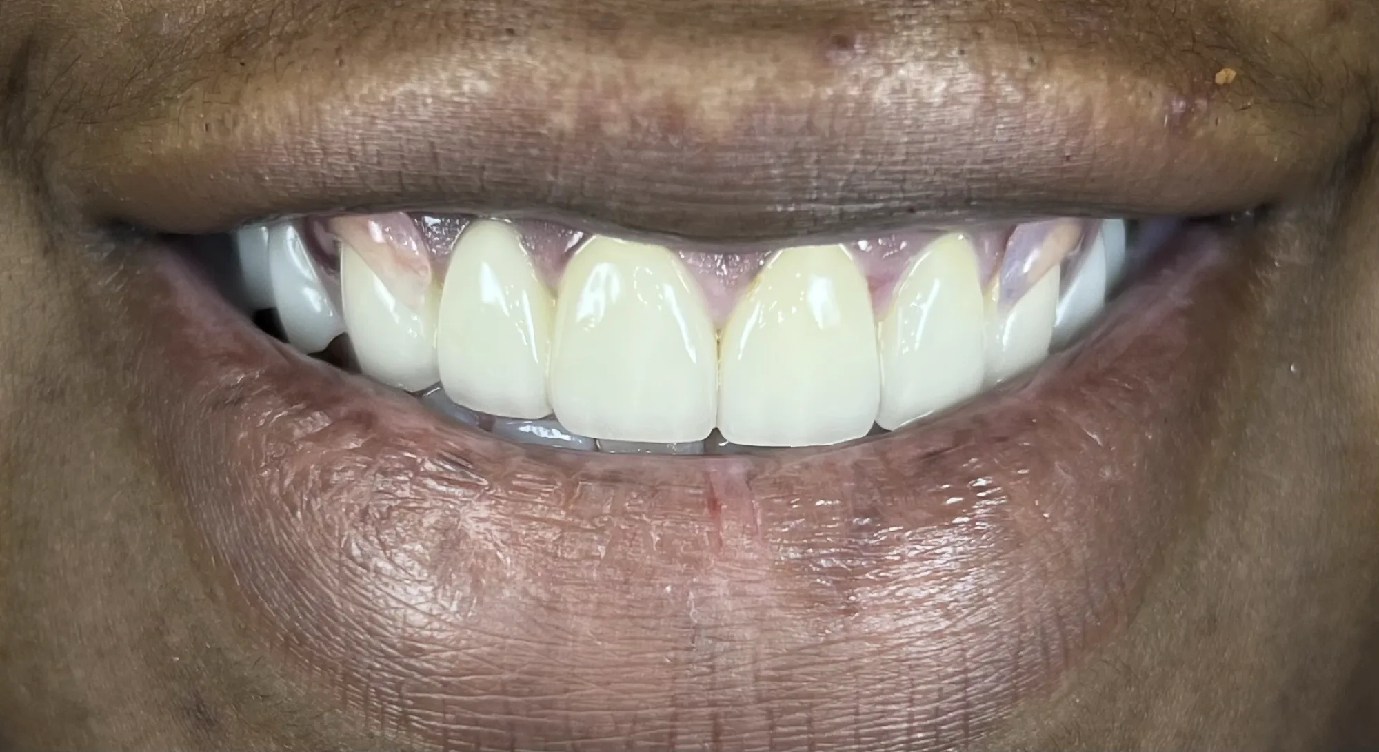 Crowns and Denture Restoration After