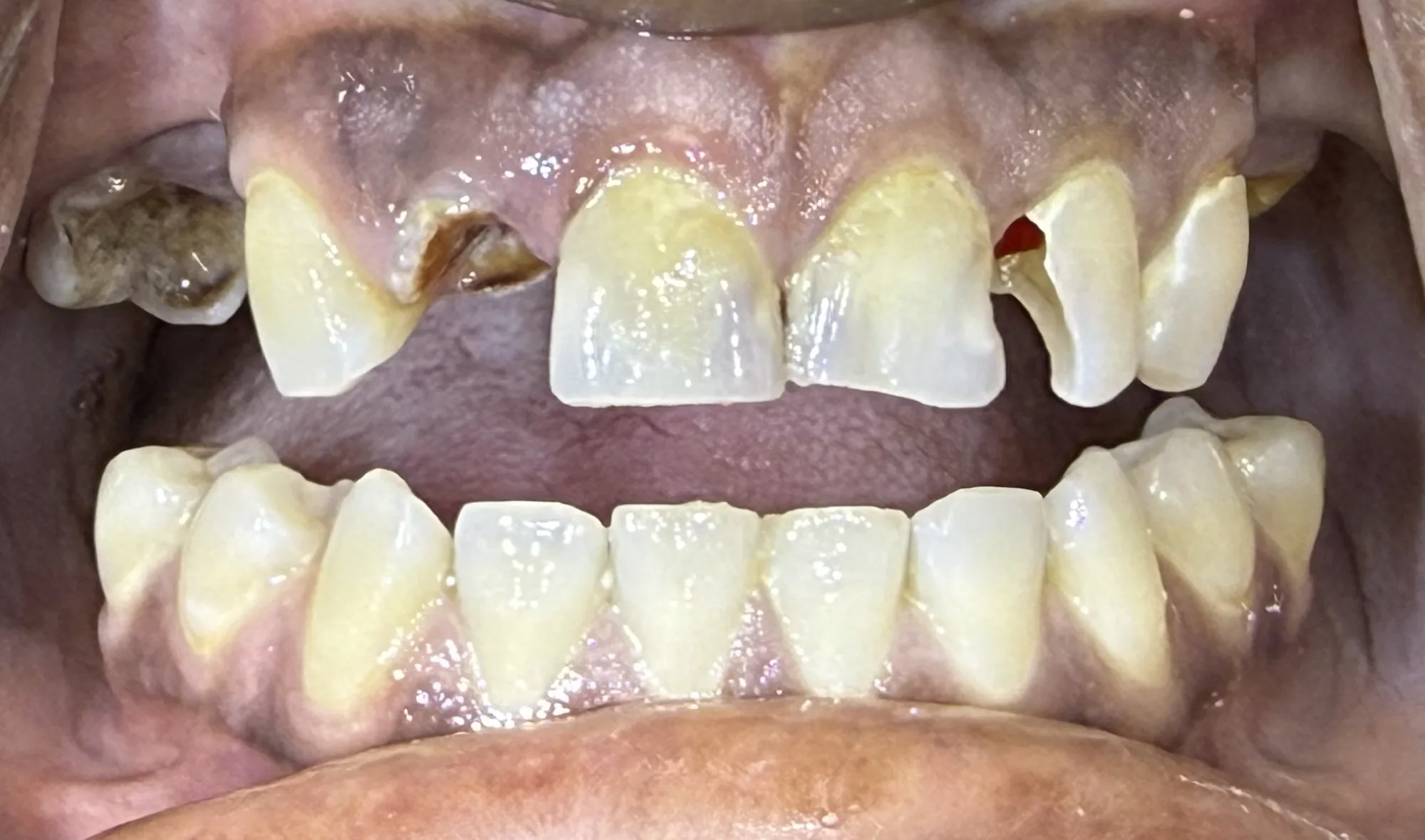 Crowns and Denture Restoration Before