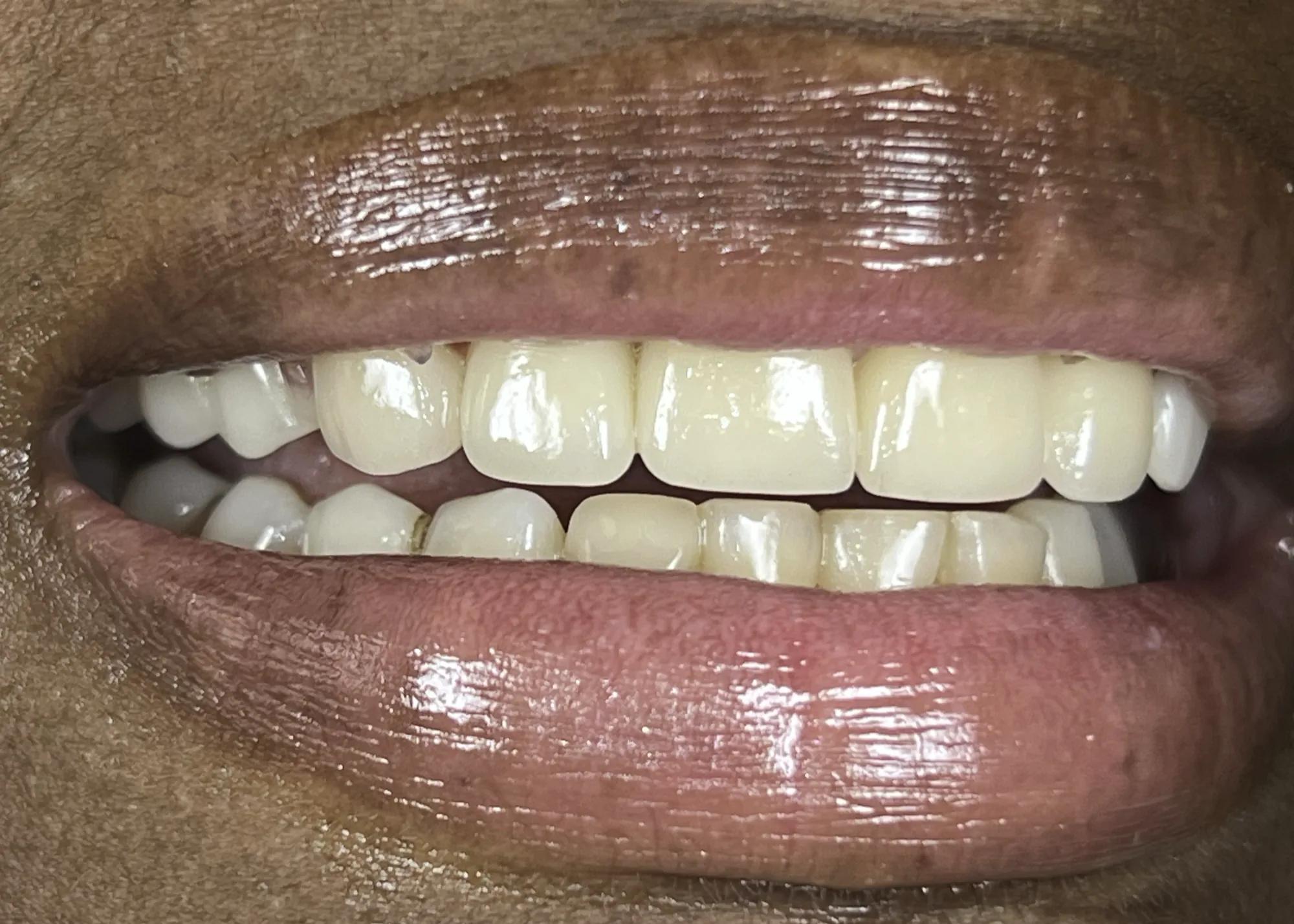 Crowns and Dentures Treatment After
