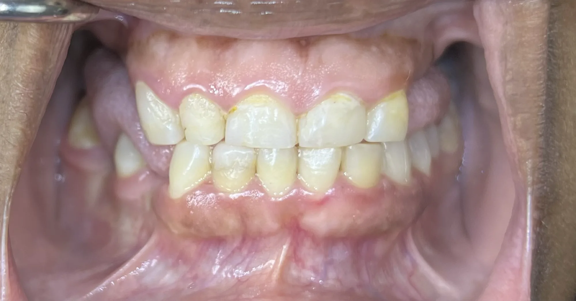Crowns and Dentures Treatment Before