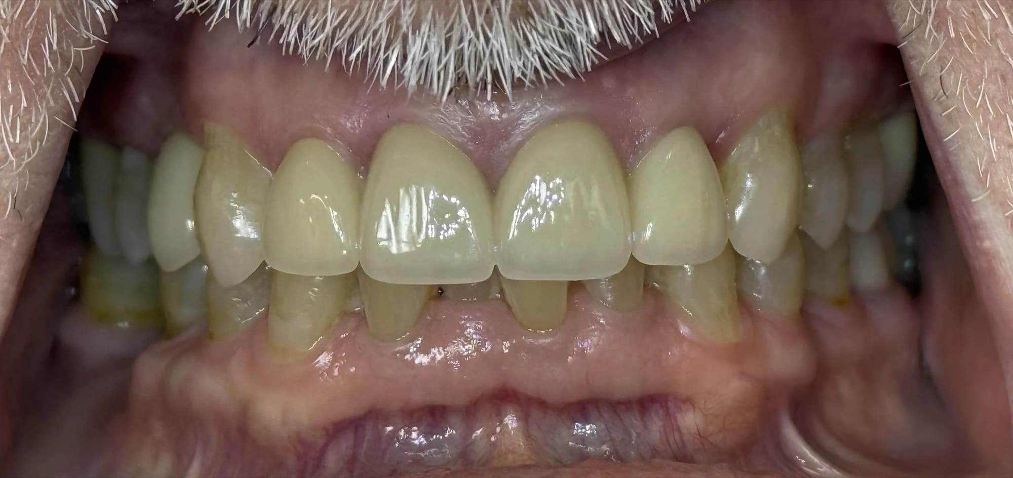Coronas e implantes Después