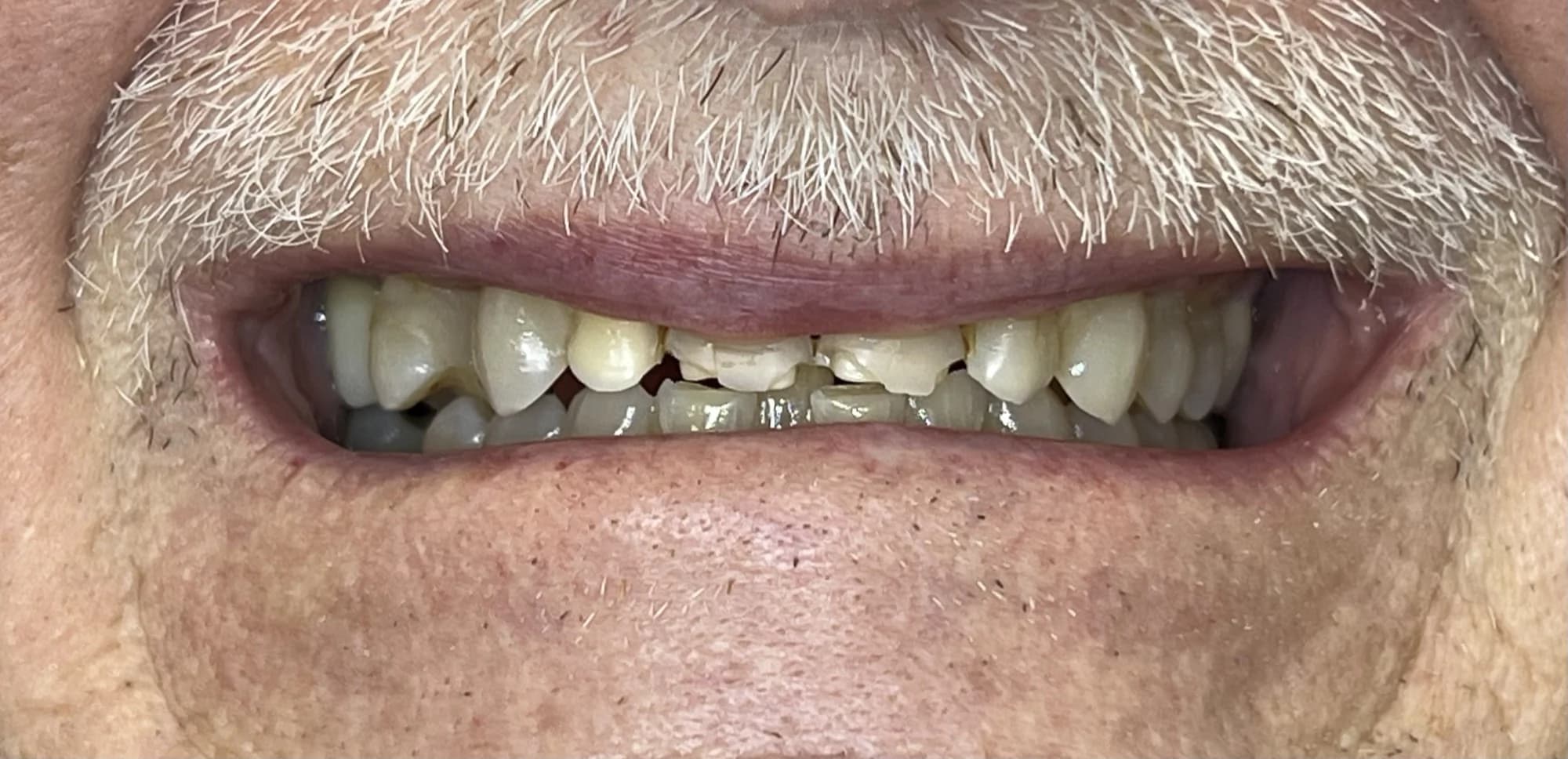 Coronas e implantes Antes
