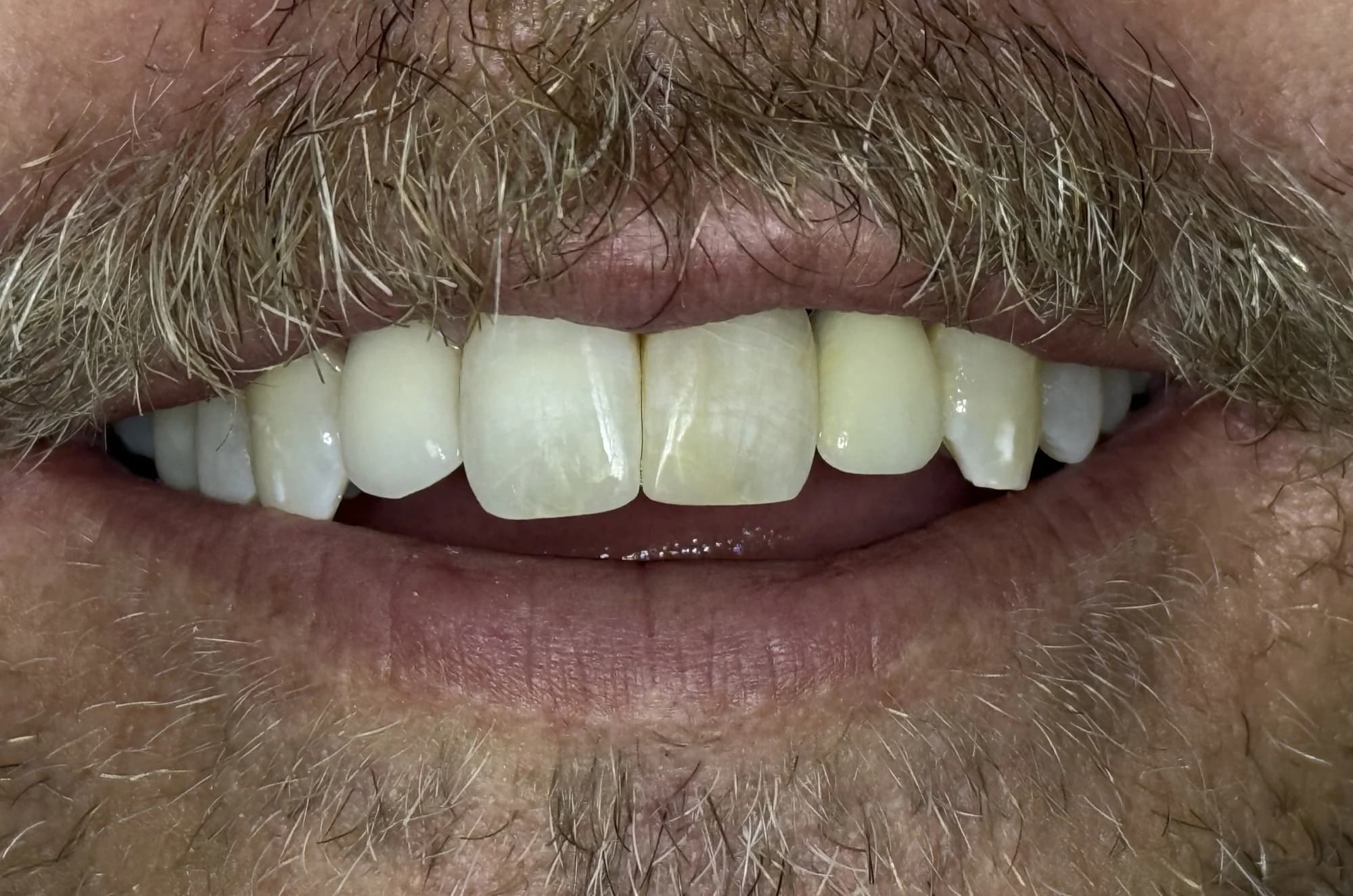 Restauración de diente frontal fracturado Después