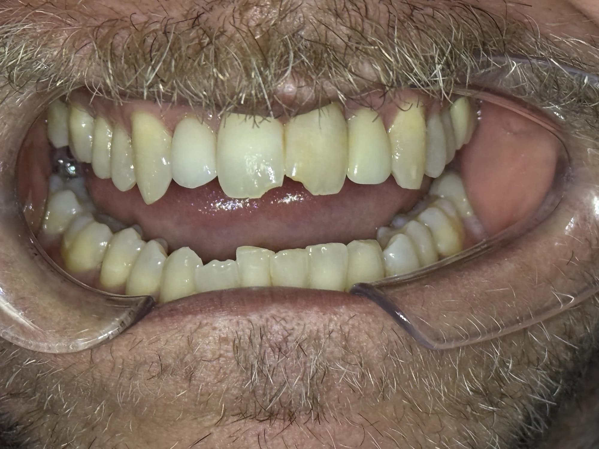 Restauración de diente frontal fracturado Antes