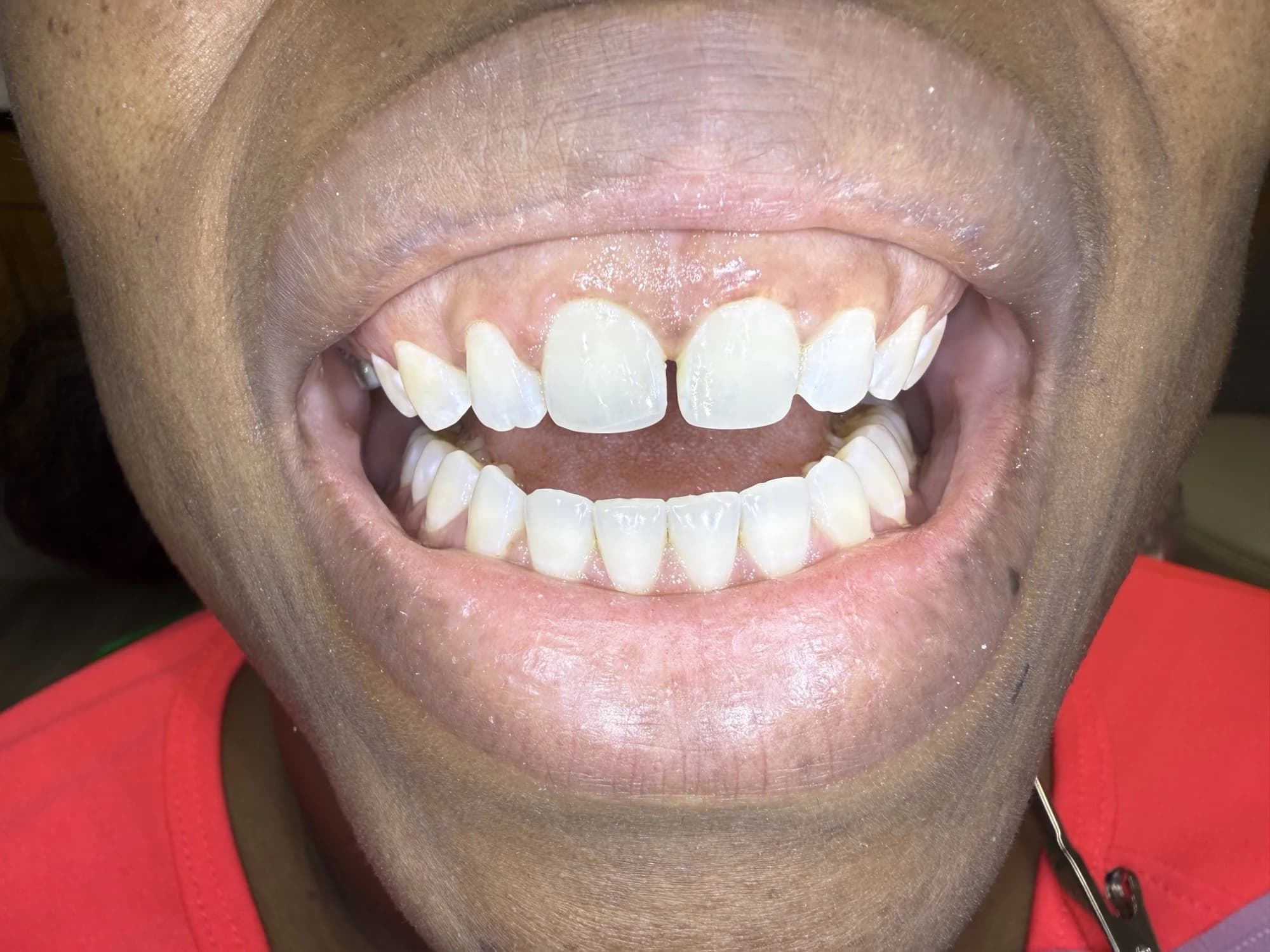 Diseño de sonrisa con bonding frontal Después