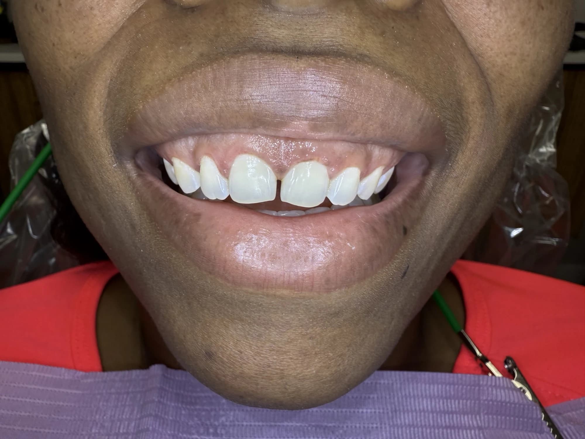 Diseño de sonrisa con bonding frontal Antes