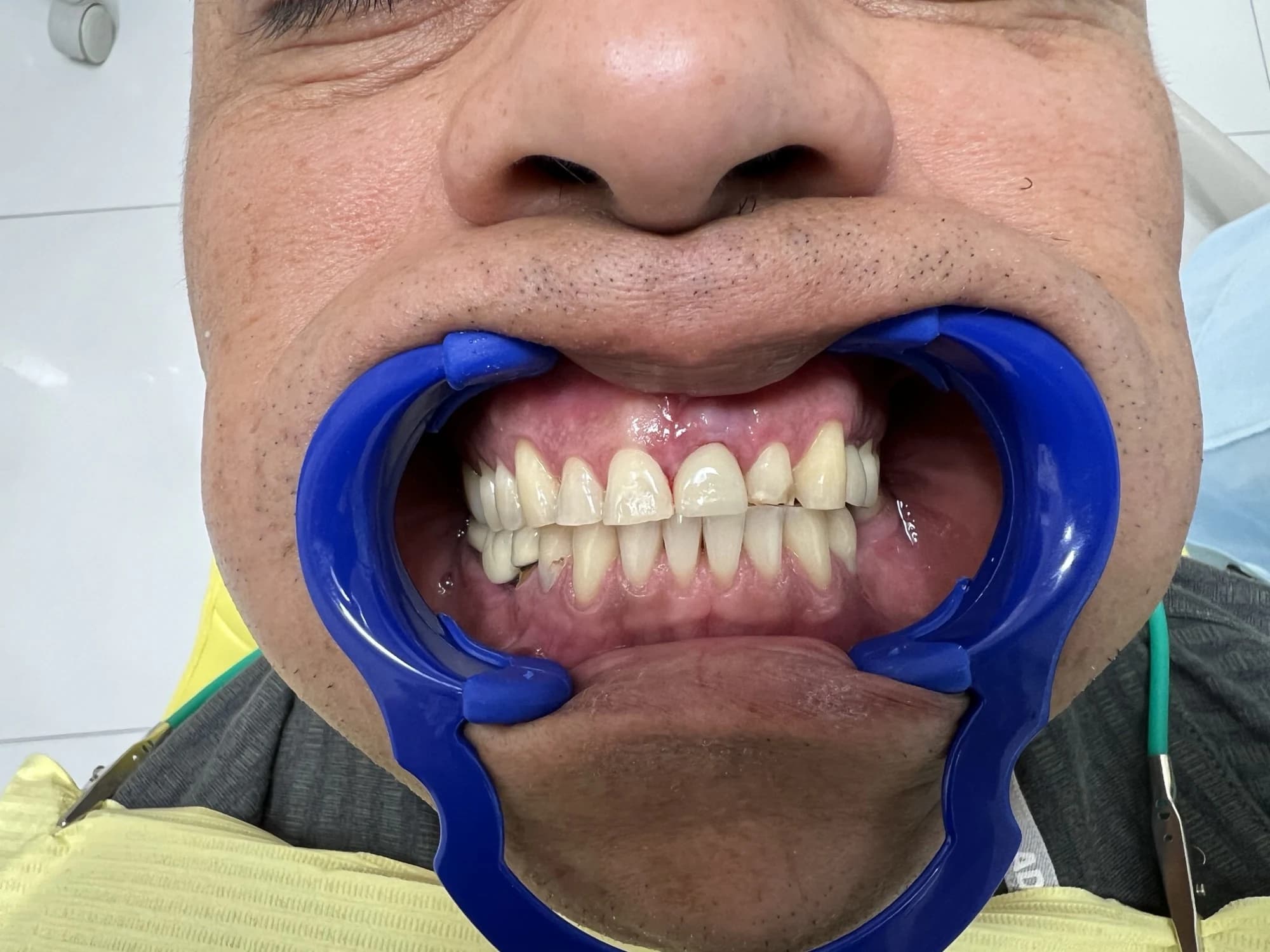 Implante de diente frontal Después