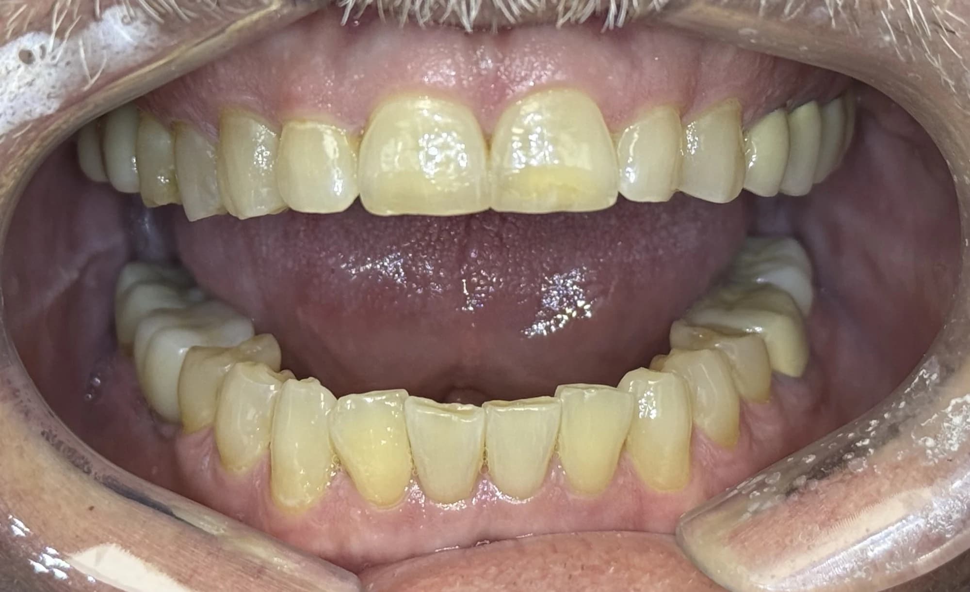 Carillas de boca completa Antes