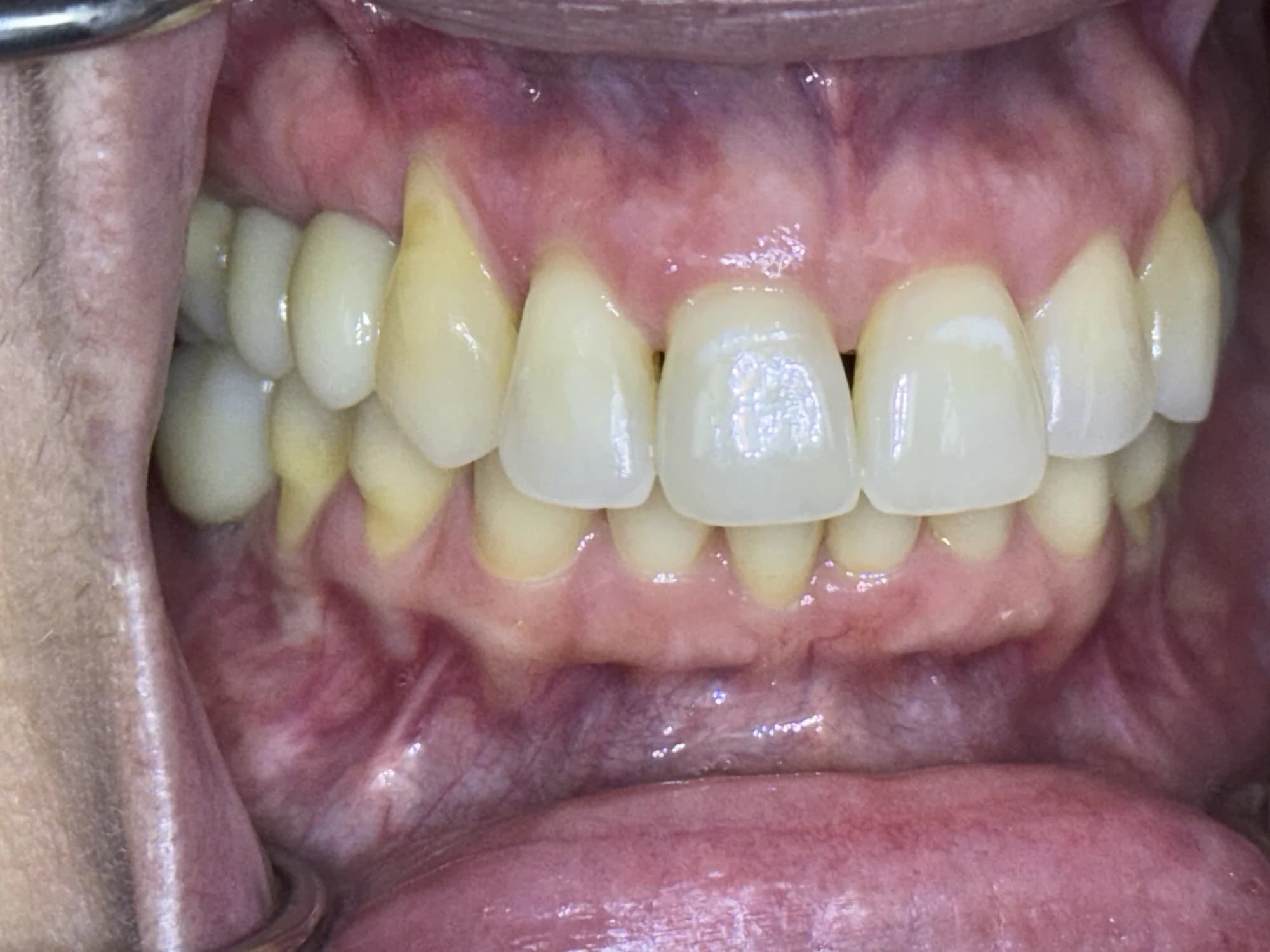Restauración de múltiples implantes Después