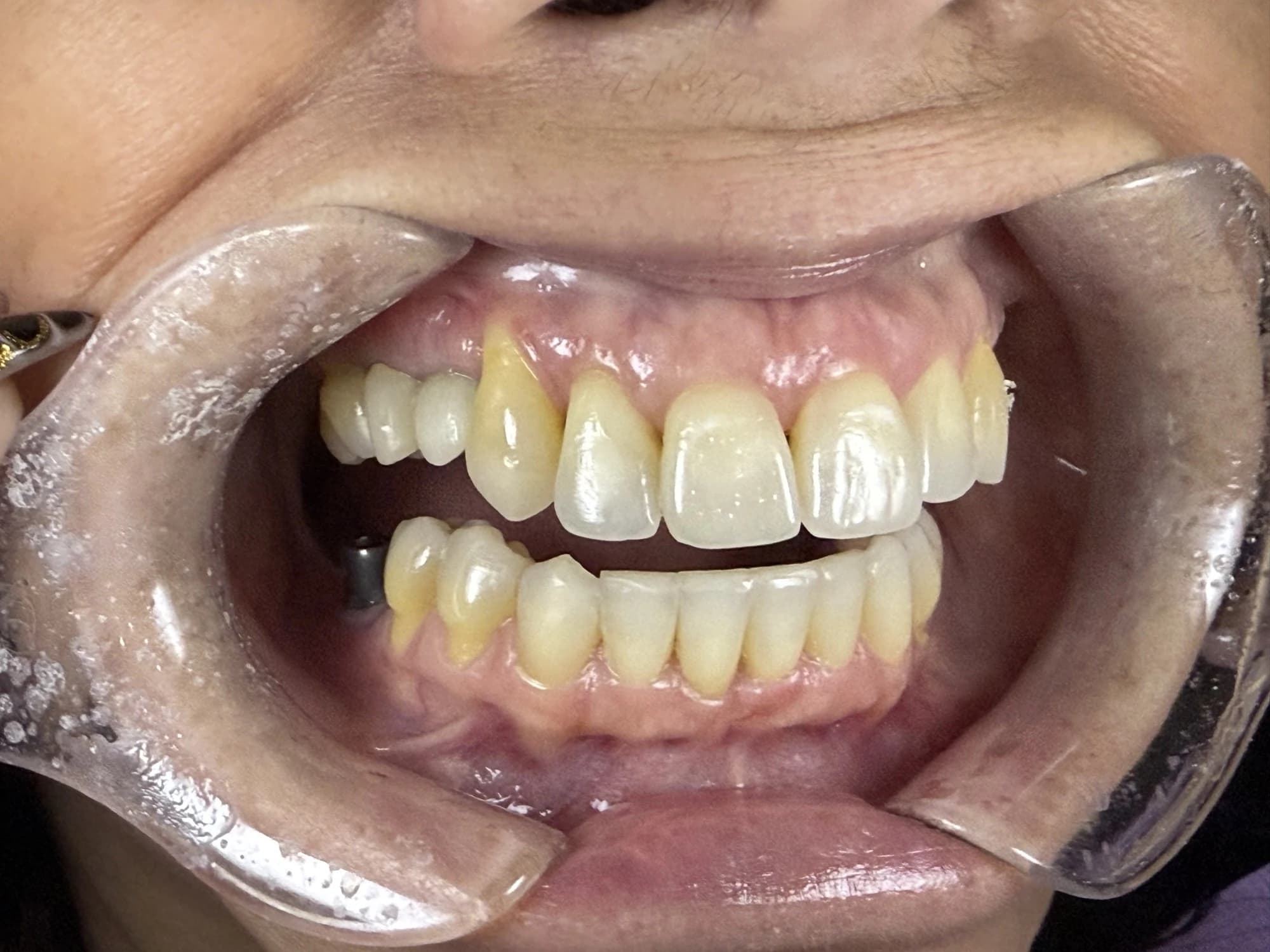 Restauración de múltiples implantes Antes