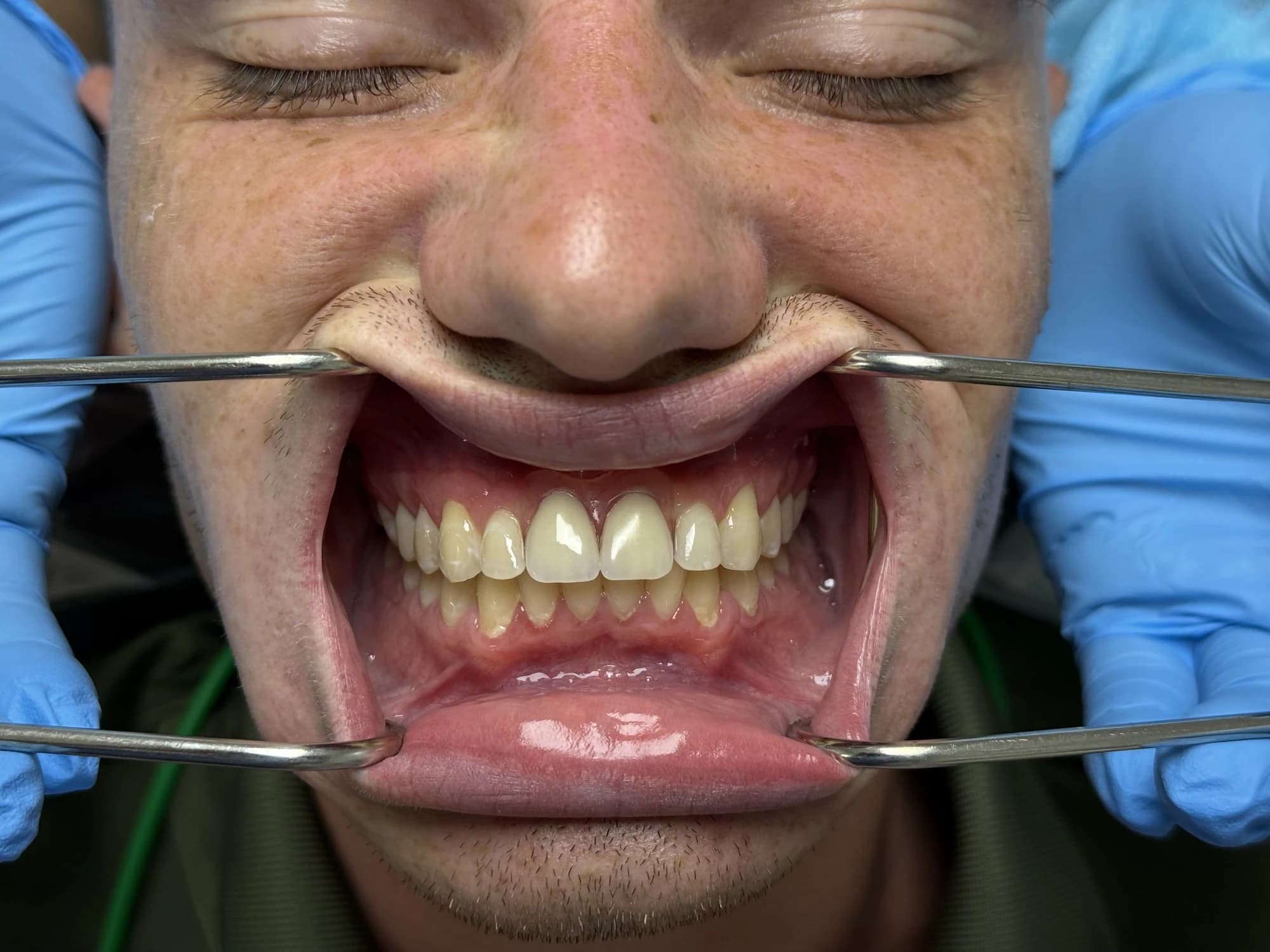 Dentadura parcial Después