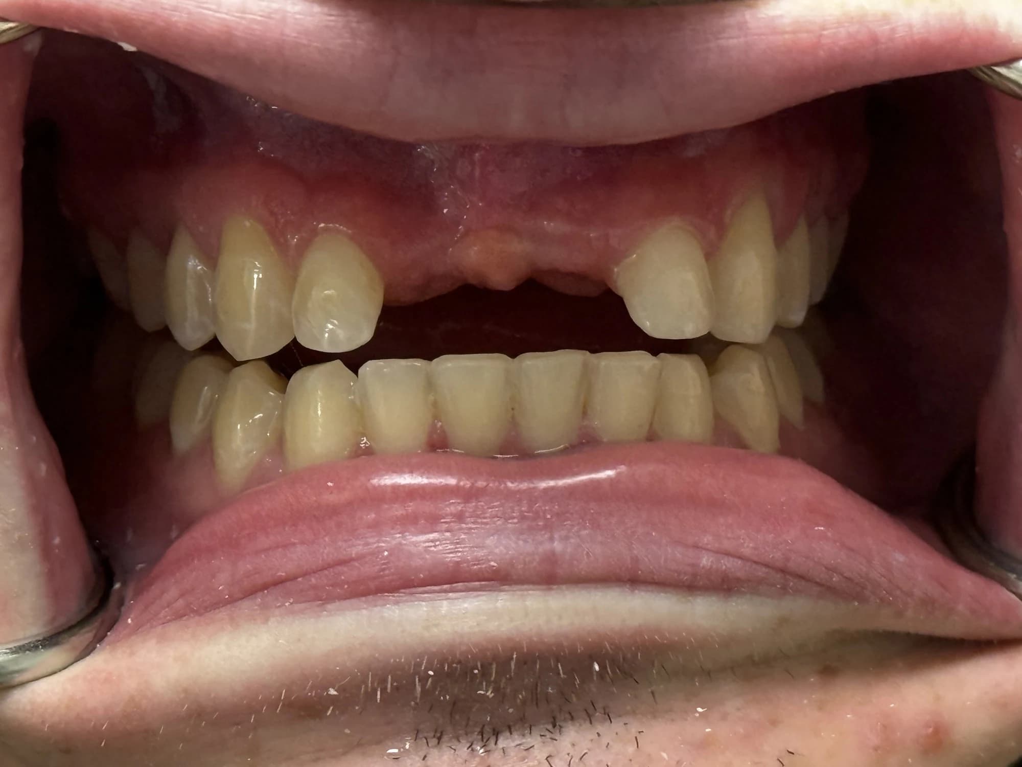 Dentadura parcial Antes