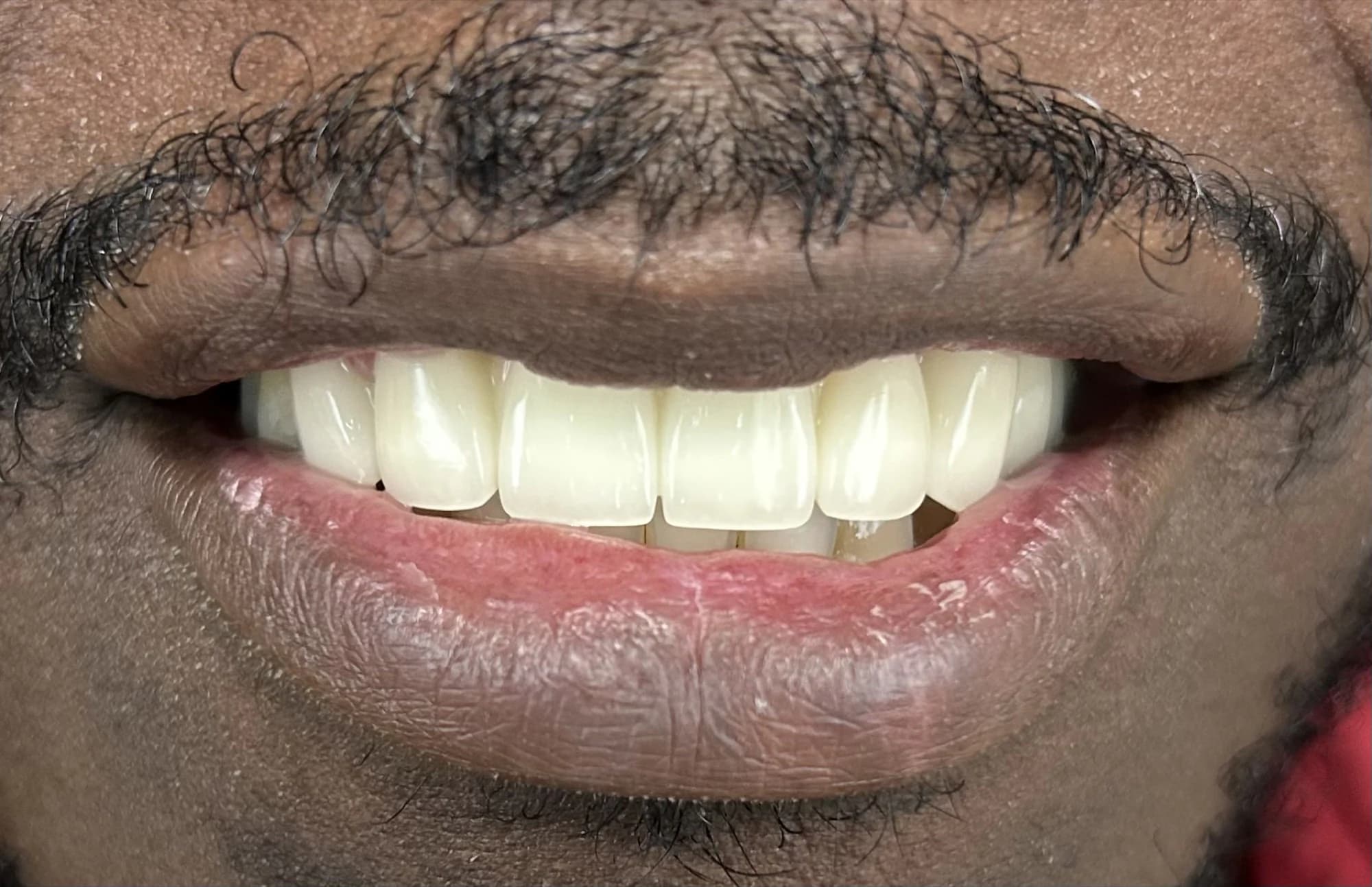 Dentaduras antes y después