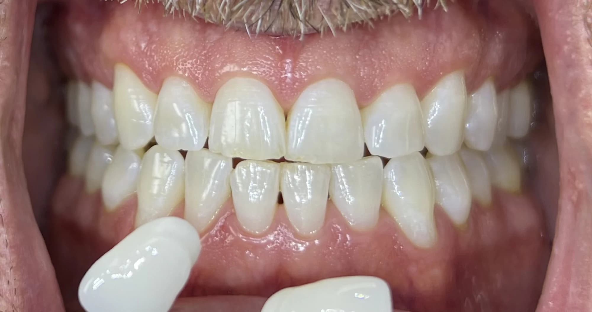 Blanqueamiento dental Antes
