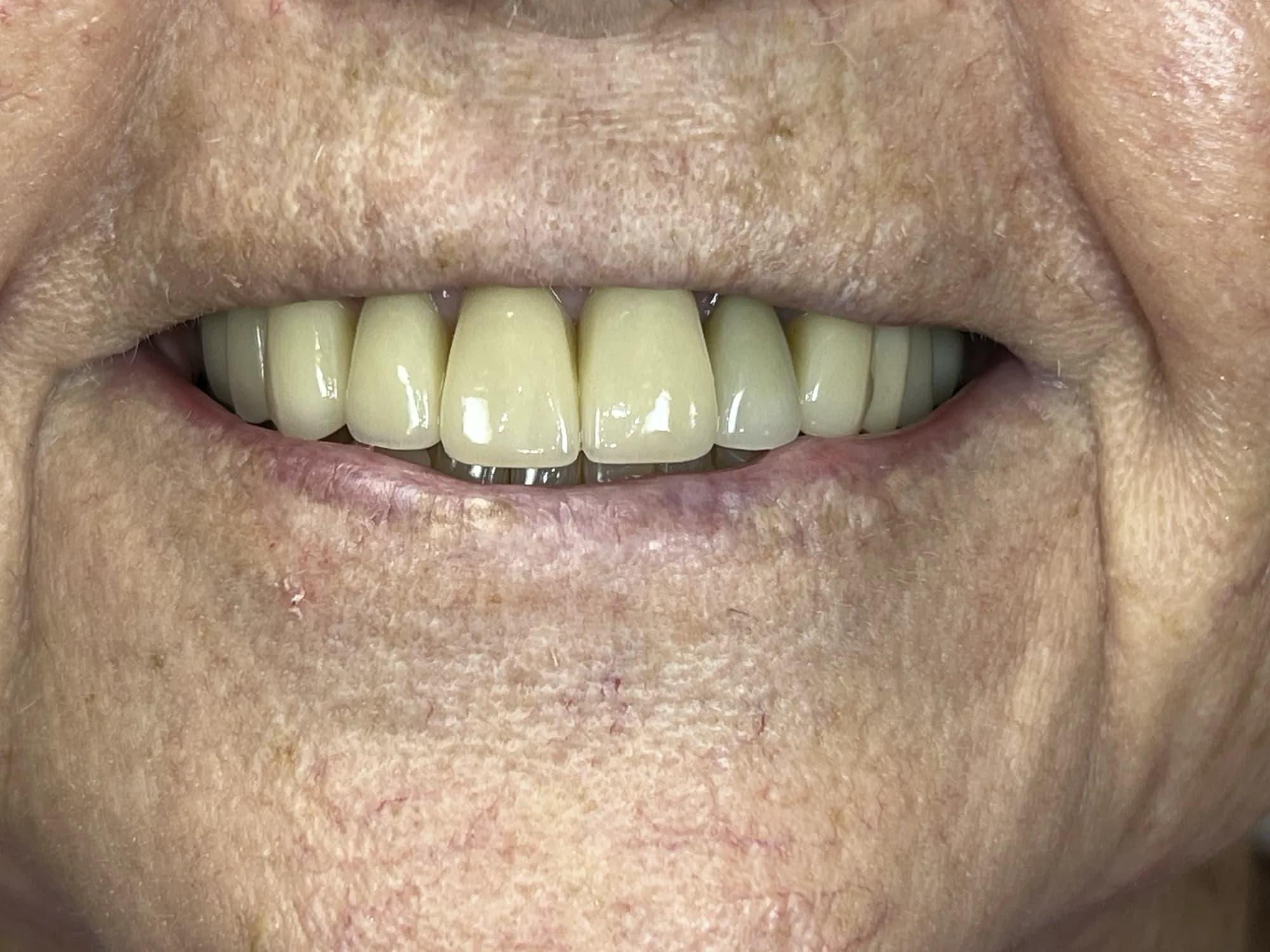 Veneers and Dental Bridge After