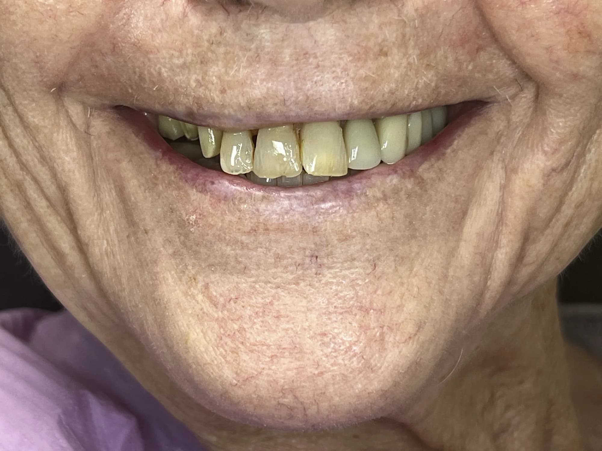 Veneers and Dental Bridge Before