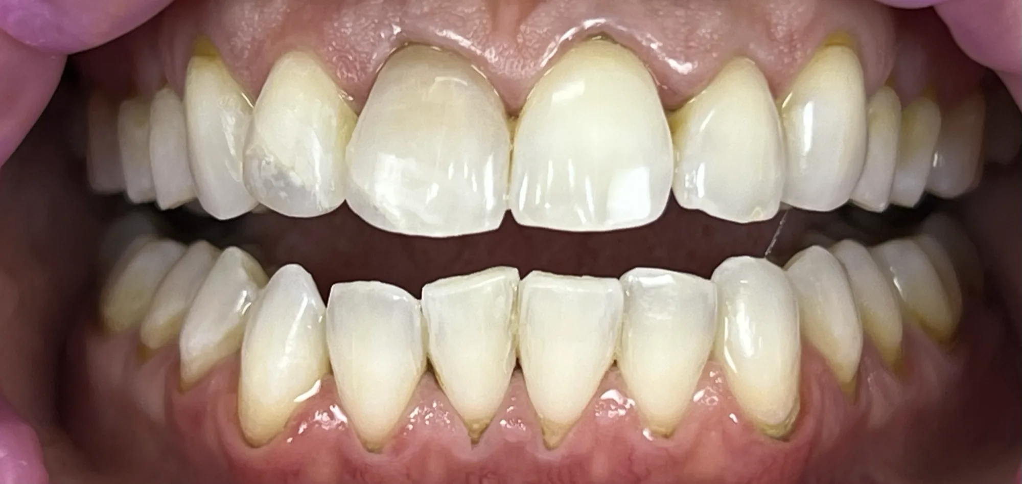 Whitening to Match Crown After