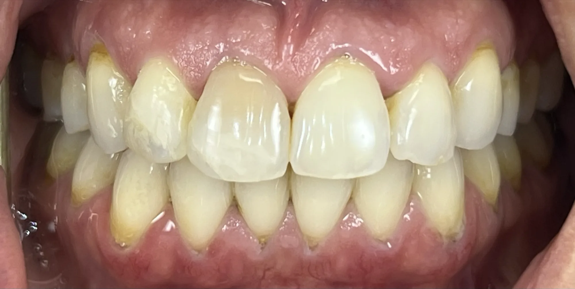 Whitening to Match Crown Before